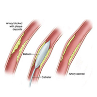 BALLOON ANGIOPLASTY